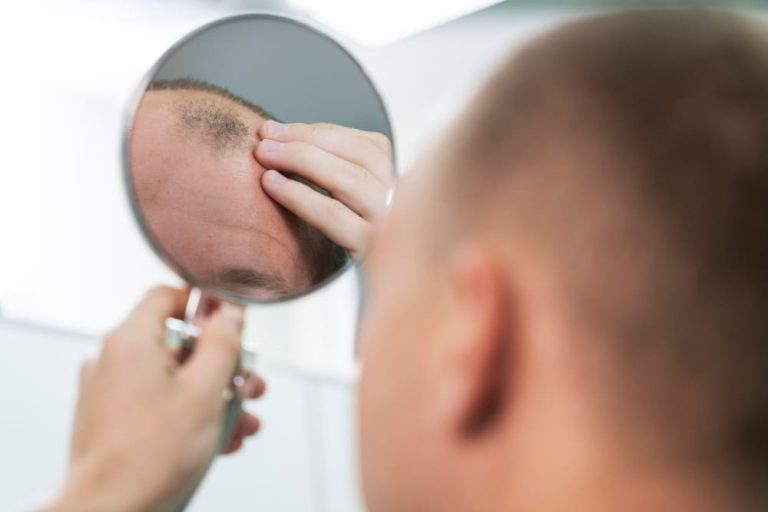 Quieres tener pelo, pues no hace falta irte a Turquía